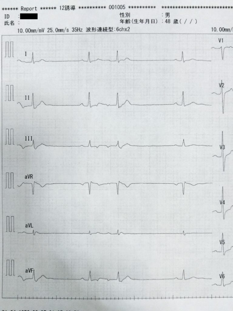 ３年前の心電図結果
