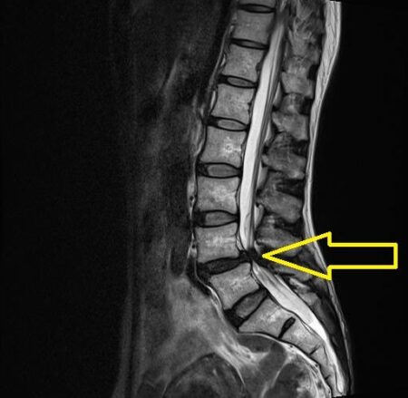 狭窄したMRI