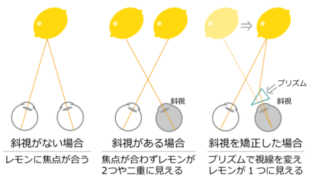 斜視とプリズムレンズ